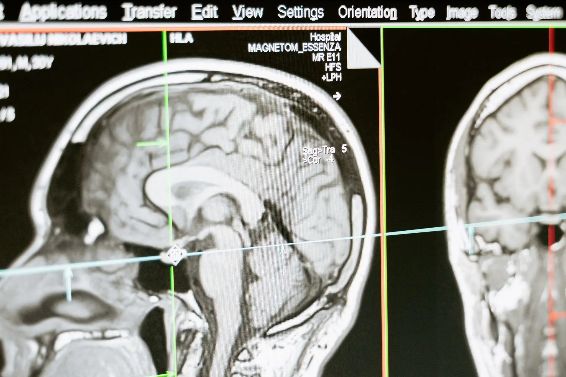 White Matter Changes on Brain MRI: Meaning, Causes, and When to Worry